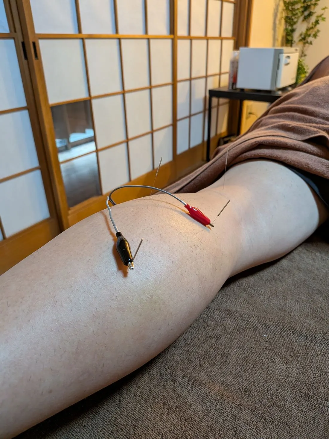 低周波鍼通電療法の施術