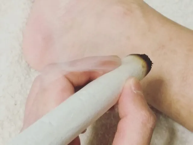 お灸を使ったセルフケアの様子