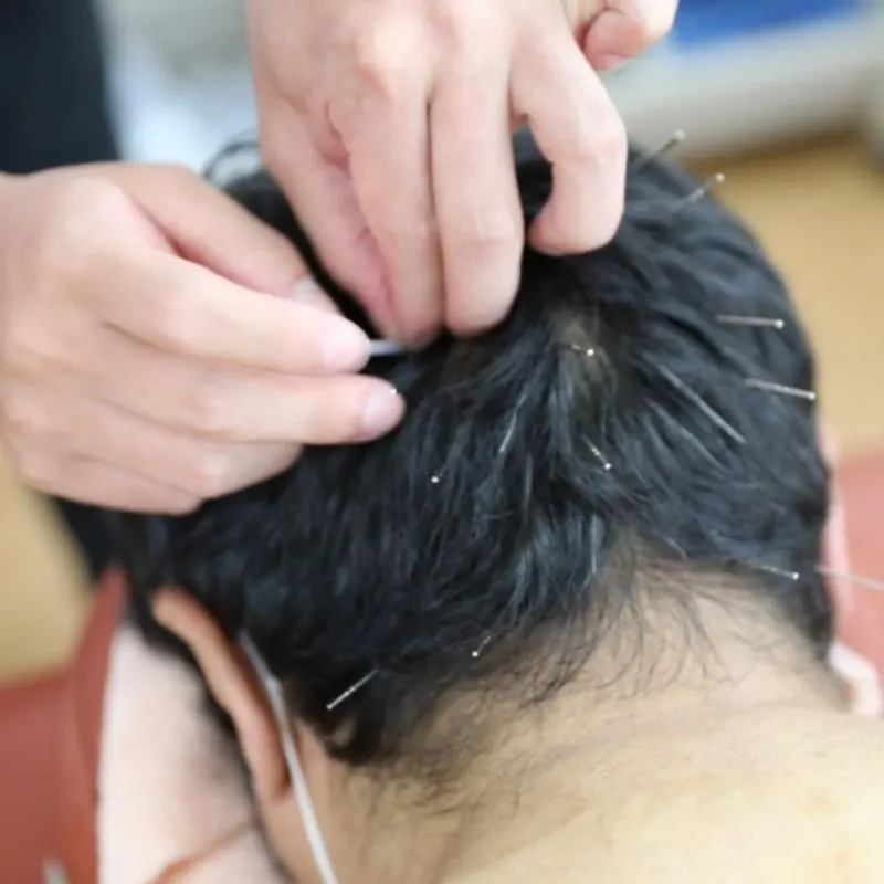 頭皮・スカルプ鍼灸施術