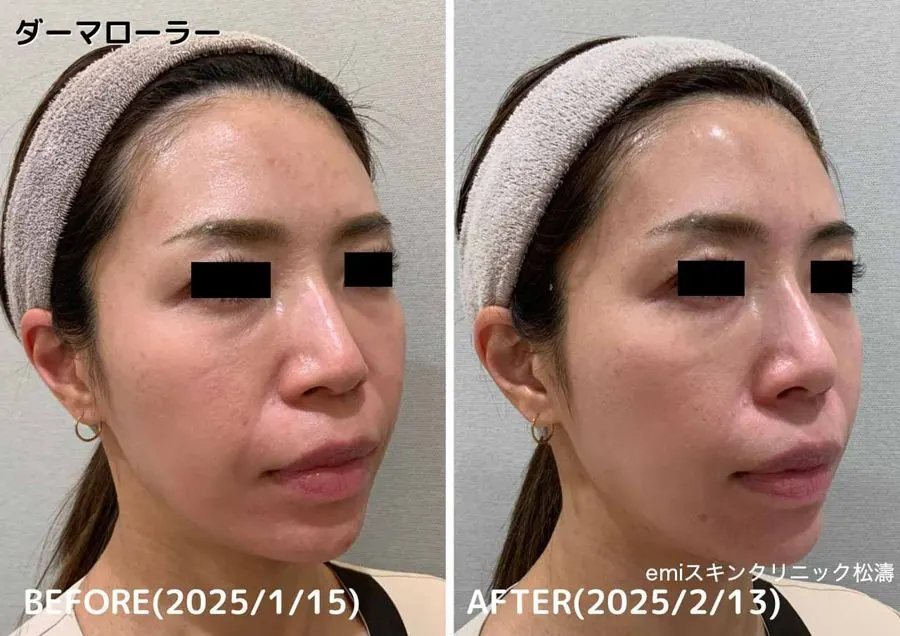 ダーマローラー使用によるビフォーアフター（2025/1/15→2025/2/13、emiスキンクリニック松濤）