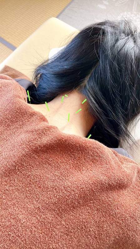 首・肩への鍼施術