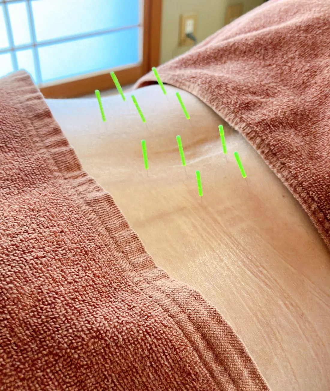 背中への鍼施術