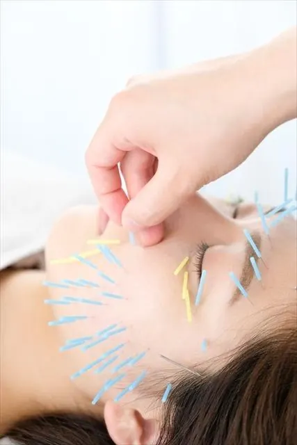 小顔美容鍼施術