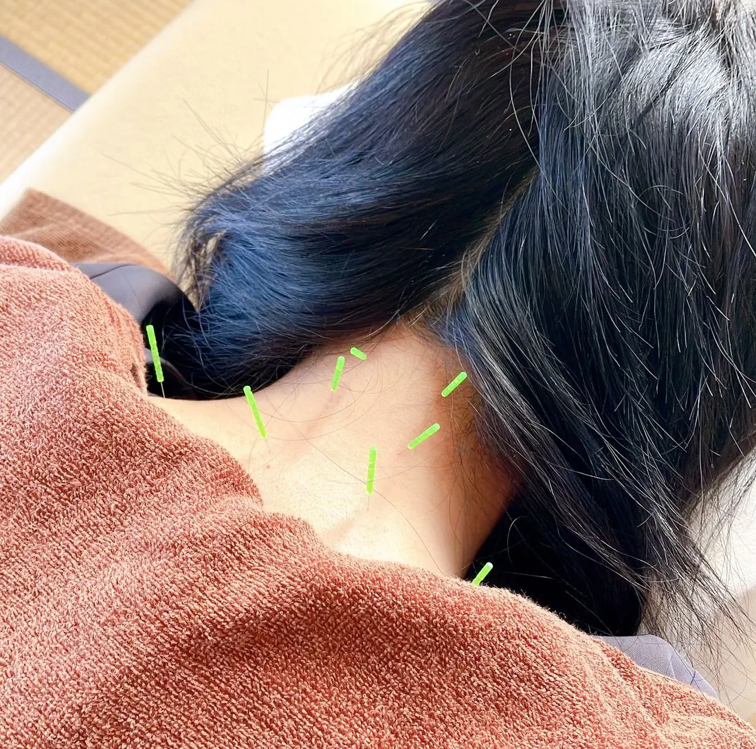 首・肩への鍼施術