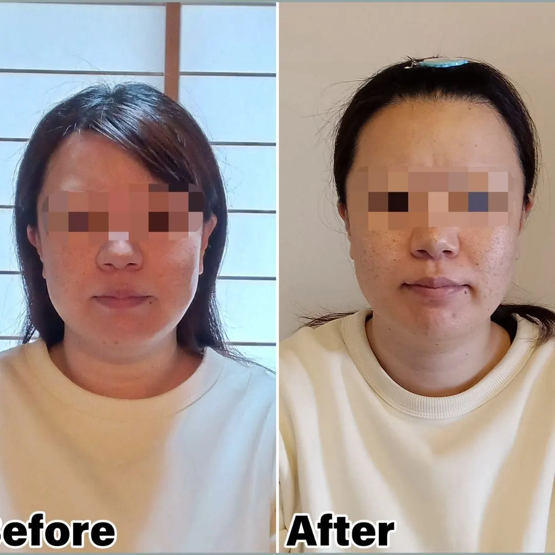 美容鍼の施術前後の比較写真
