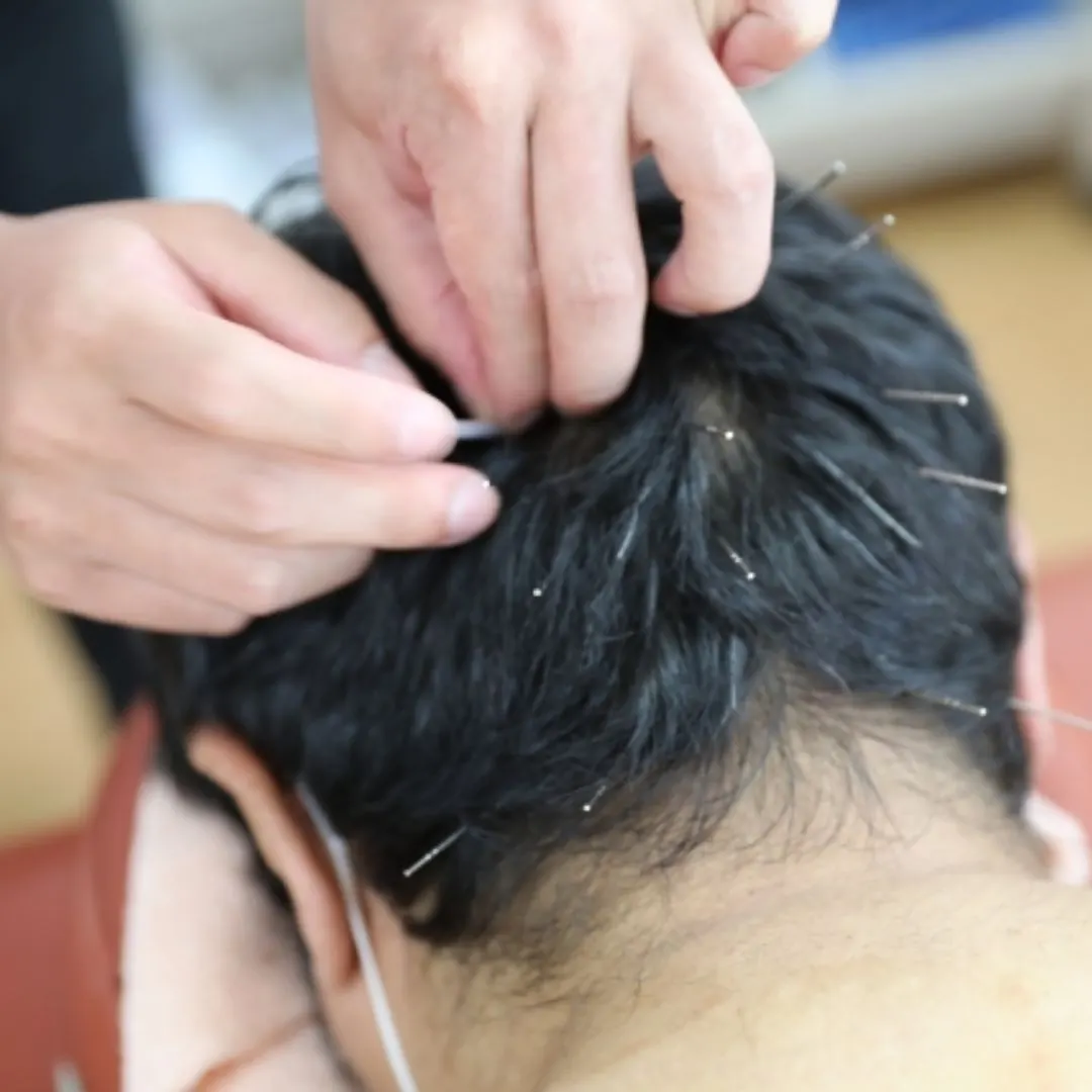 頭皮・スカルプ鍼灸